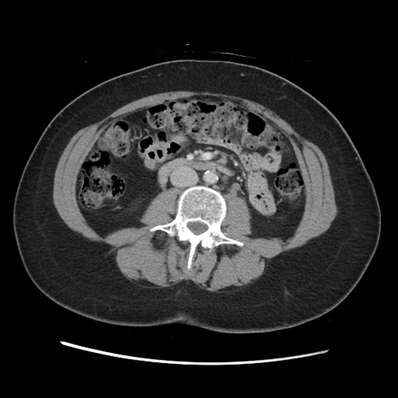 Sarcoidosis | Radiology Case | Radiopaedia.org