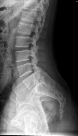 Lumbarization of S1 vertebra | Image | Radiopaedia.org