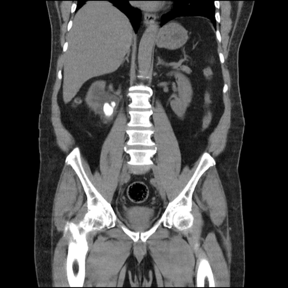 Right ureteric and renal pelvis calculus Image