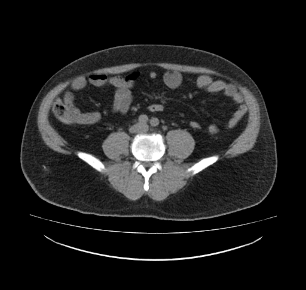 Right ureteric and renal pelvis calculus Image