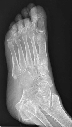 Great toe osteomyelitis and Sudeck atrophy of foot | Radiology Case ...