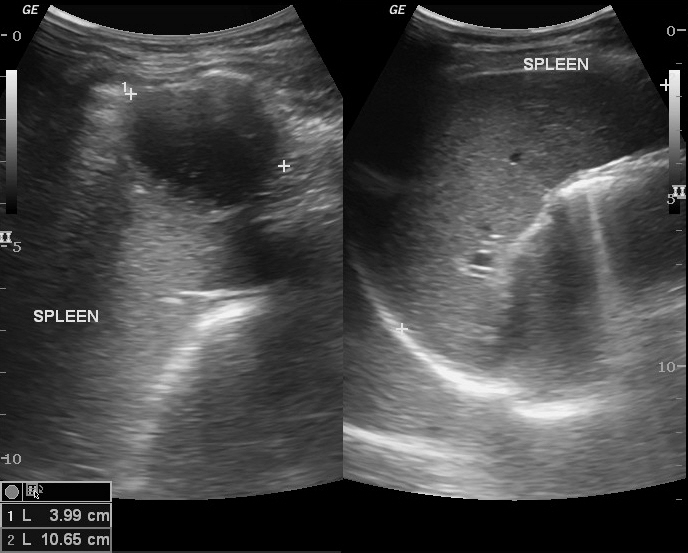 Chest wall abscesses | Image | Radiopaedia.org