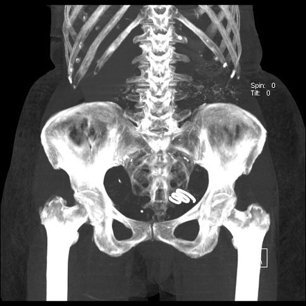 Migrated intrauterine contraceptive device - Lippes Loop | Image ...