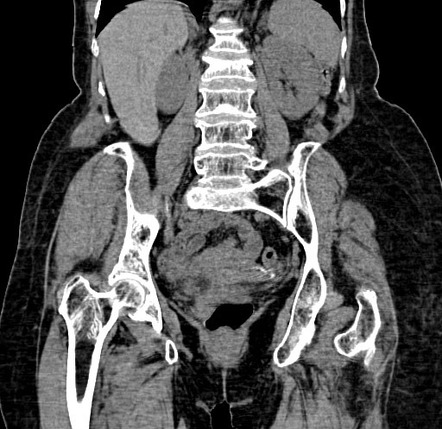 Migrated intrauterine contraceptive device - Lippes Loop | Image ...