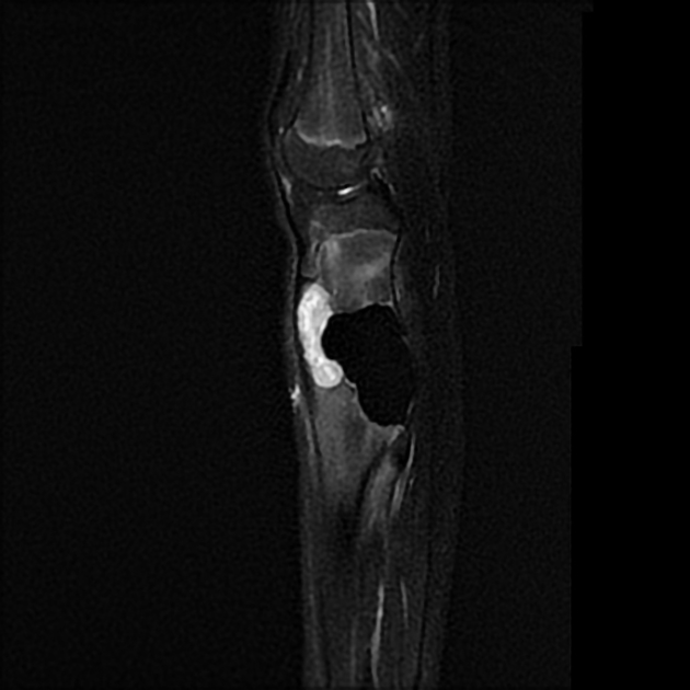 Chondromyxoid fibroma | Radiology Reference Article | Radiopaedia.org