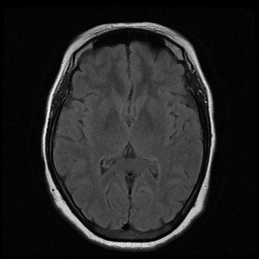 Pituitary macroadenoma with apoplexy | Image | Radiopaedia.org