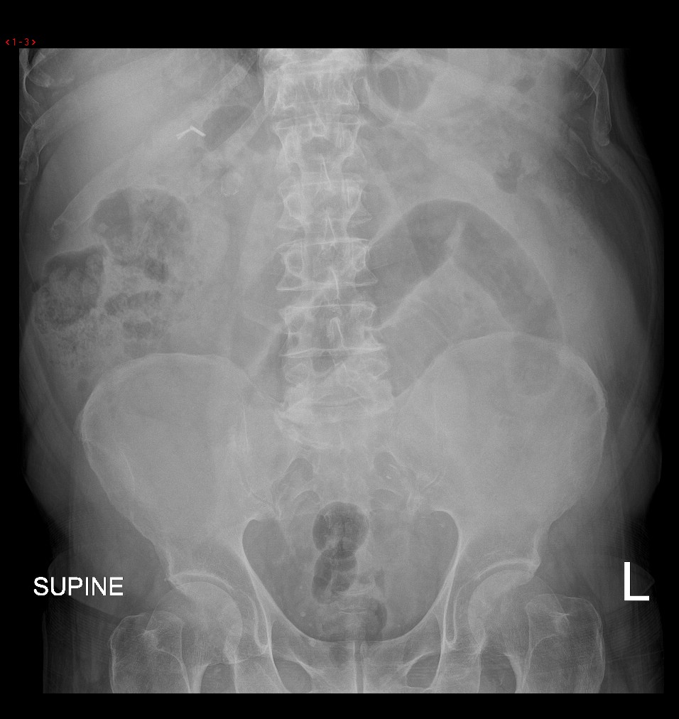 Small Bowel Obstruction Due To An Inguinal Hernia Radiology Case Hot