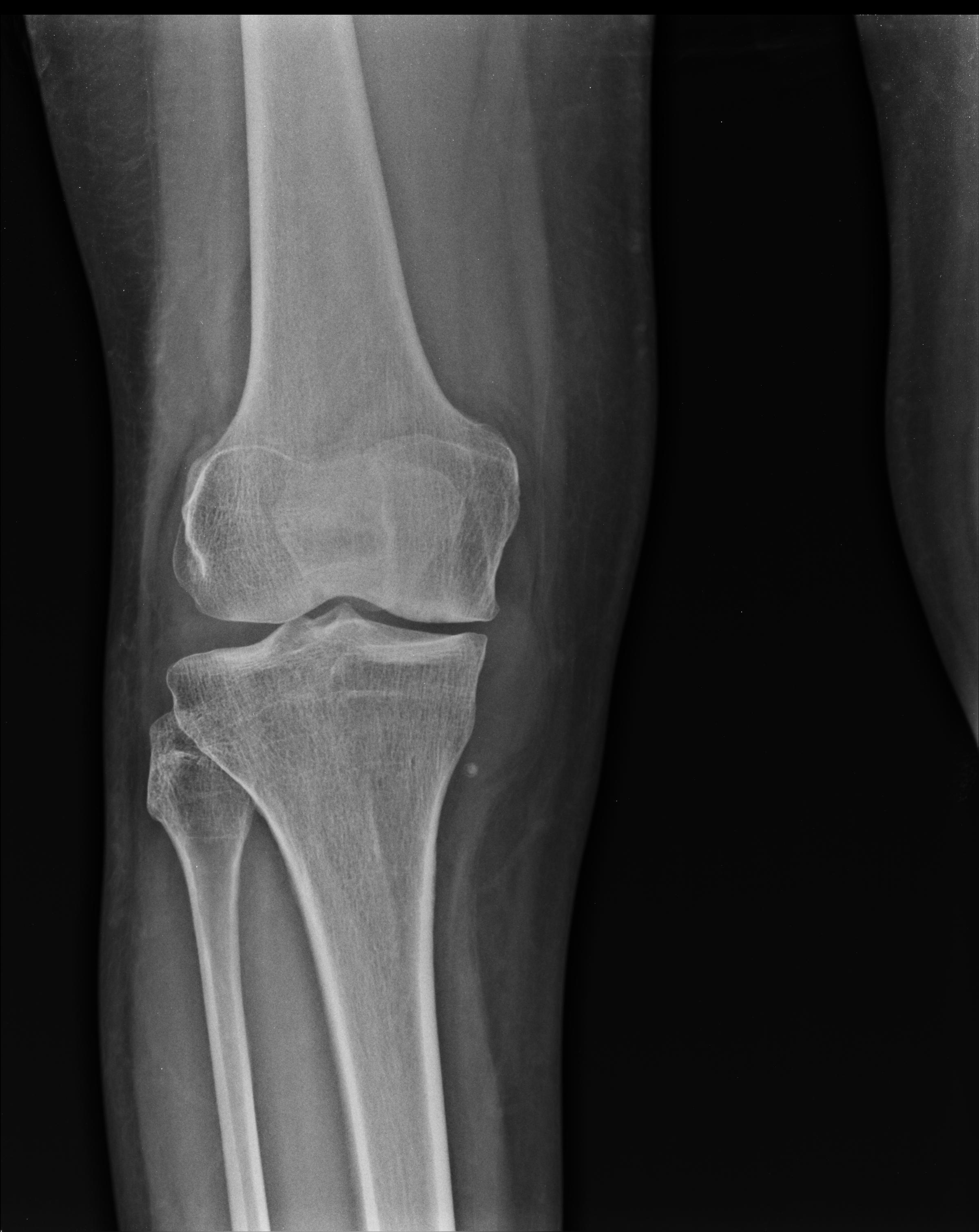 Medial Meniscal Cyst 