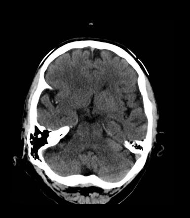 MCA dot sign | Radiology Case | Radiopaedia.org