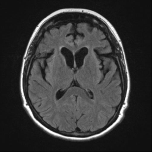 Frontotemporal dementia - behavioral variant | Image | Radiopaedia.org