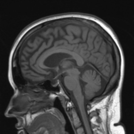 Behavioural variant frontotemporal lobar degeneration | Radiology ...