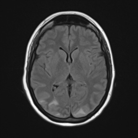 PRES with cerebellar involvement and hemorrhage | Image | Radiopaedia.org