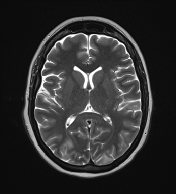 PRES with cerebellar involvement and hemorrhage | Image | Radiopaedia.org