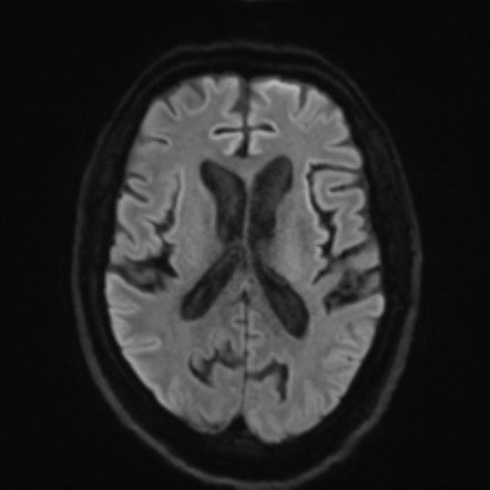 FTD-MND - behavioral variant frontotemporal dementia | Image ...