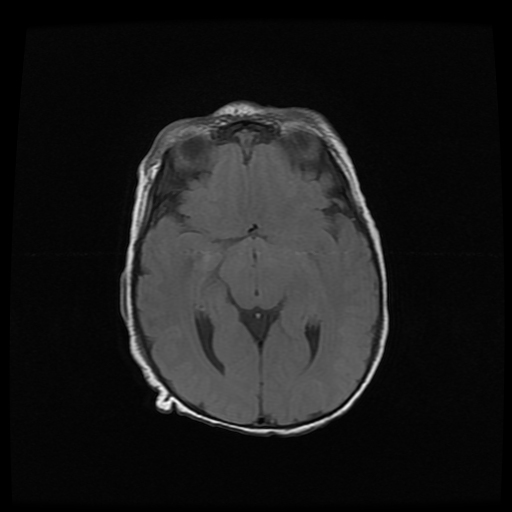 Bilateral perisylvian polymicrogyria | Image | Radiopaedia.org