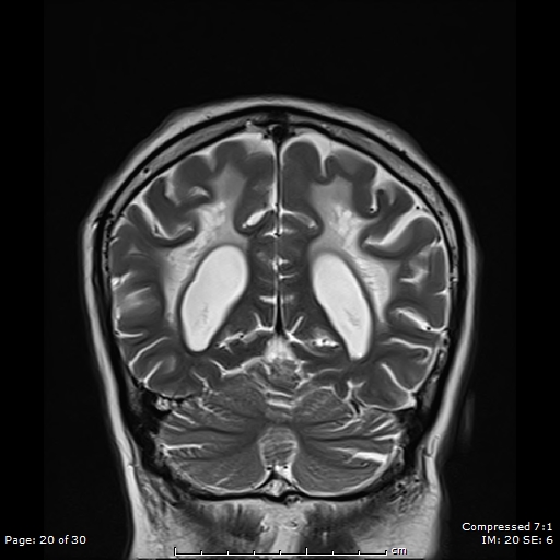 Adult-onset vanishing white matter disease | Image | Radiopaedia.org