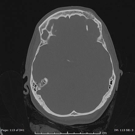 Intraosseous hemangioma - frontal bone | Radiology Case | Radiopaedia.org