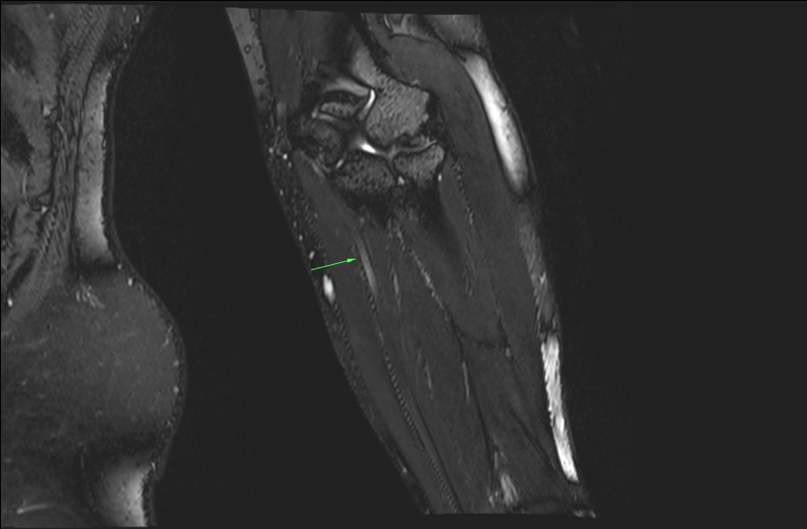 Cubital Tunnel Syndrome 