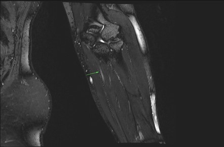 Cubital tunnel syndrome | Image | Radiopaedia.org