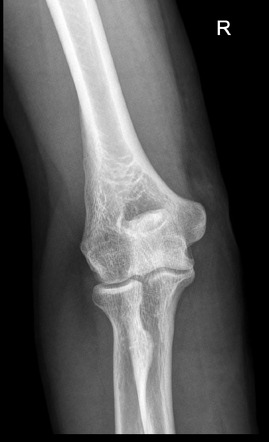 Subcutaneous emphysema | Radiology Case | Radiopaedia.org