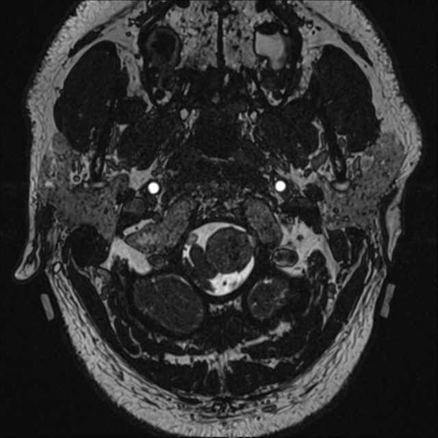 Schwannoma - foramen magnum | Image | Radiopaedia.org