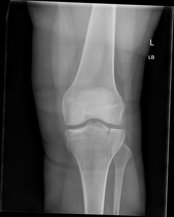 Lateral tibial plateau fracture with lipohaemarthrosis | Radiology Case ...