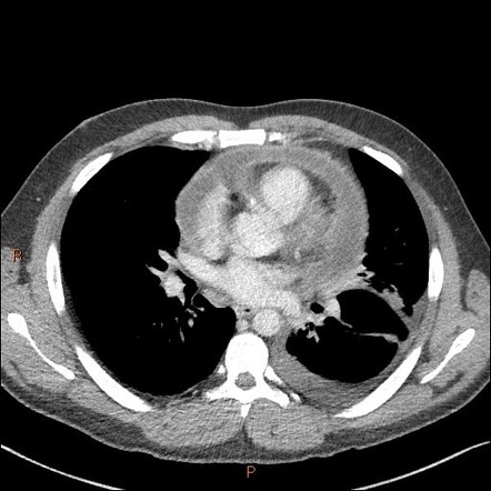 Pericarditis | Radiology Reference Article | Radiopaedia.org