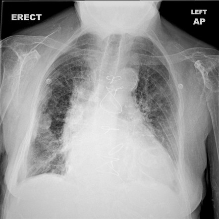 Pleural pseudotumor | Radiology Case | Radiopaedia.org