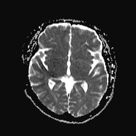 Acute superior sagittal sinus thrombosis | Image | Radiopaedia.org