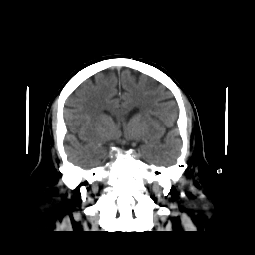 Acute Superior Sagittal Sinus Thrombosis 