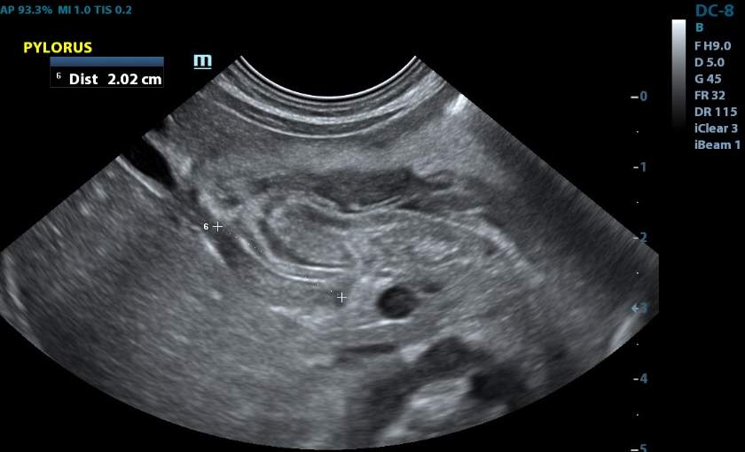 Infantile Hypertrophic Pyloric Stenosis