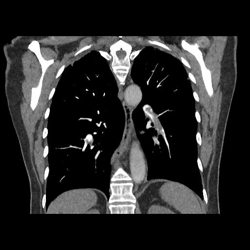 Pulmonary embolism | Image | Radiopaedia.org