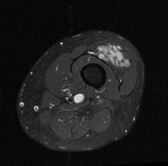 Soft Tissue Hemangioma Intramuscular Image Radiopaedia Org