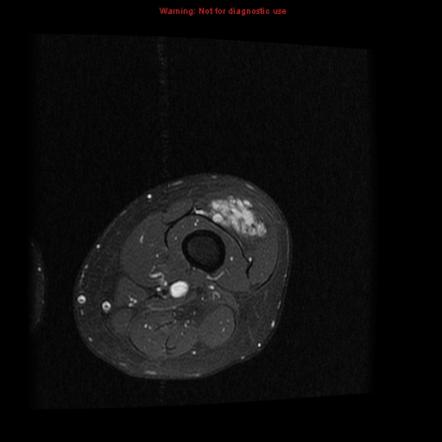 Soft tissue venous malformations | Radiology Reference Article