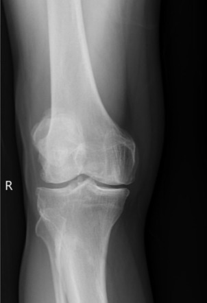 Osteoarthritis | Radiology Case | Radiopaedia.org