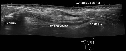 Latissimus dorsi muscle injury | Radiology Case | Radiopaedia.org