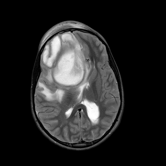 Pott Puffy Tumor With Cerebral Abscesses Image