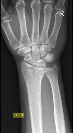 Distal radial fracture | Radiology Case | Radiopaedia.org