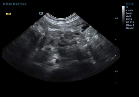 Recurrent Intussusception Diagnosis And Reduction Image