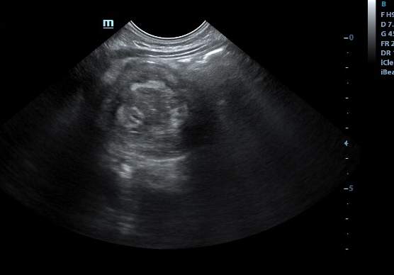 Recurrent Intussusception Diagnosis And Reduction Image