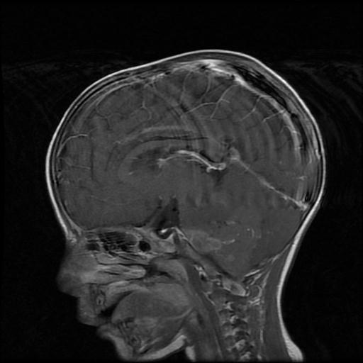 Ependymoma - 4th ventricle | Image | Radiopaedia.org