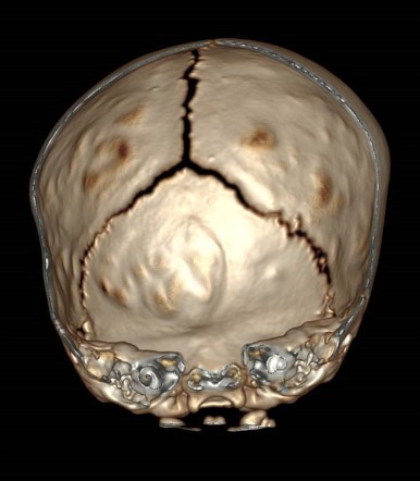 Anterior plagiocephaly | Image | Radiopaedia.org