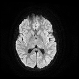 Tolosa-Hunt syndrome | Image | Radiopaedia.org