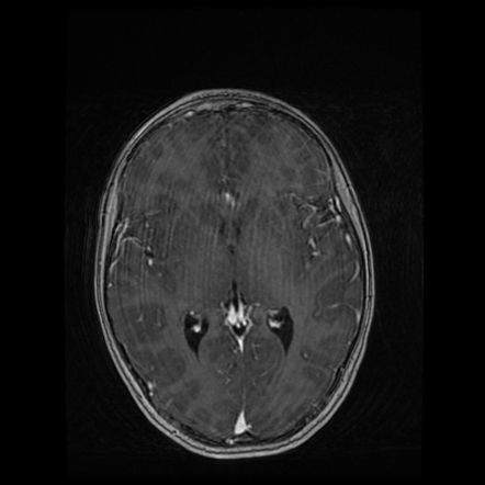 Tolosa-Hunt syndrome | Image | Radiopaedia.org