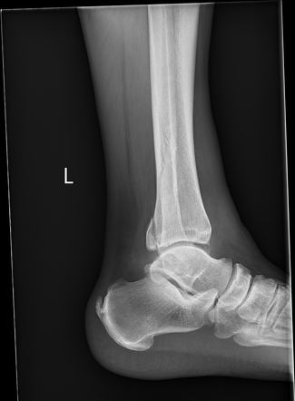 Trimalleolar fracture | Image | Radiopaedia.org