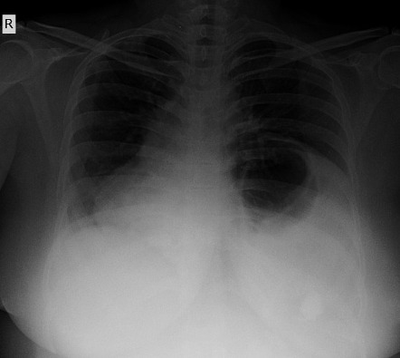 Diaphragmatic Eventration Radiology Reference Article Radiopaedia Org