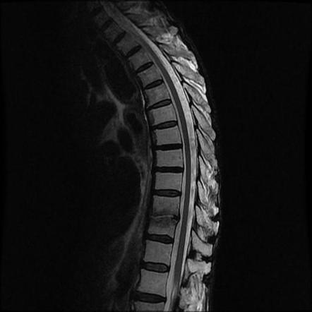 Spondylodiscitis | Image | Radiopaedia.org