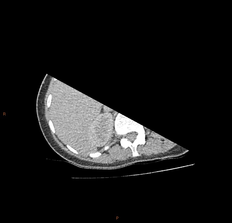 File:Tuberculosis - pleural, pulmonary, discitis (Radiopaedia 92606 ...