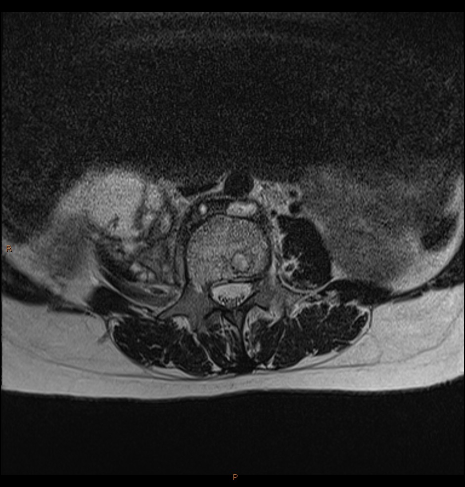 File:Tuberculosis - pleural, pulmonary, discitis (Radiopaedia 92606 ...