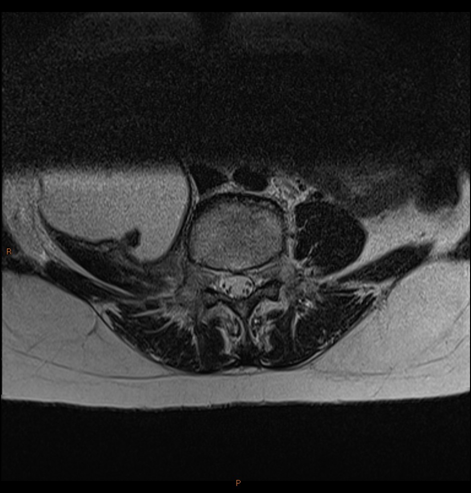 File:Tuberculosis - pleural, pulmonary, discitis (Radiopaedia 92606 ...